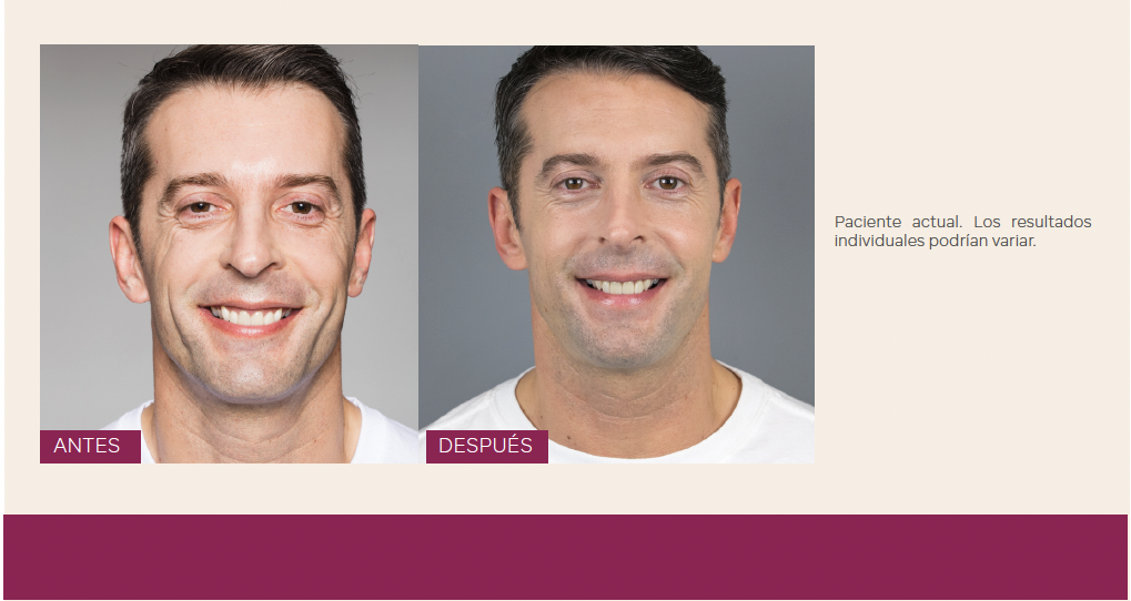 Sculptra Antes y Después